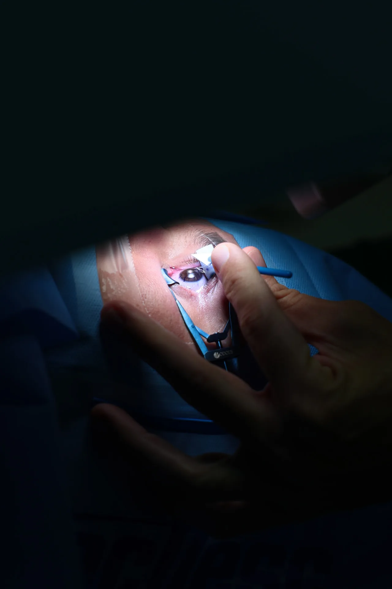 Cirurgia Refrativa a Laser